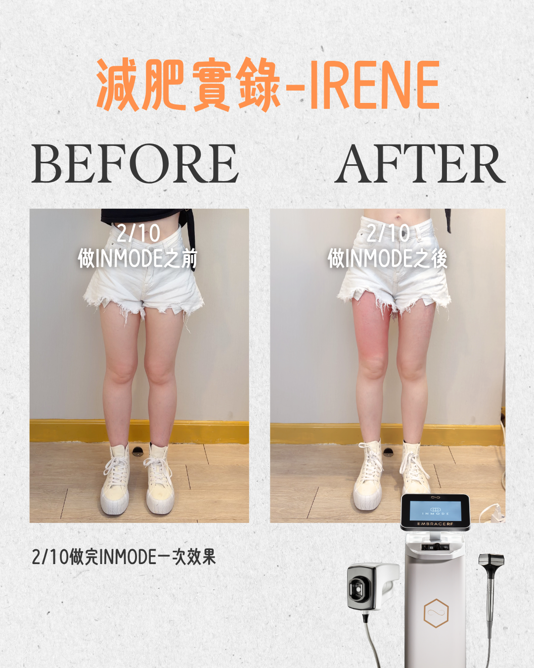 IRENE INMODE - 2
